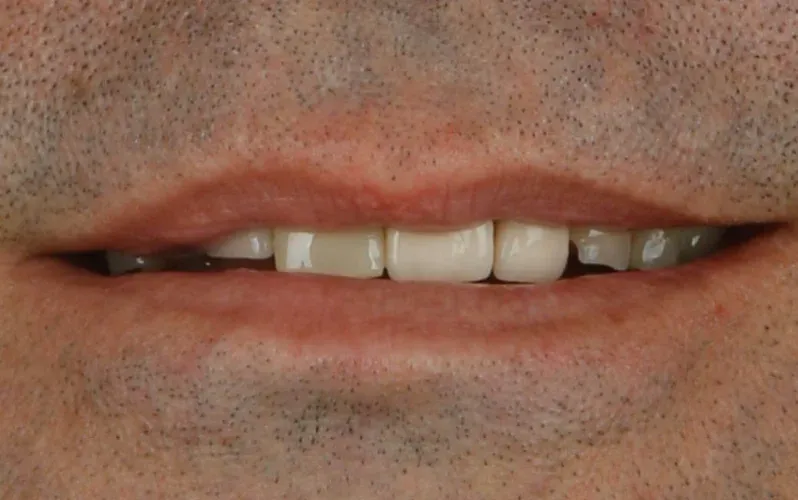Antes — Lentes de contato de porcelana