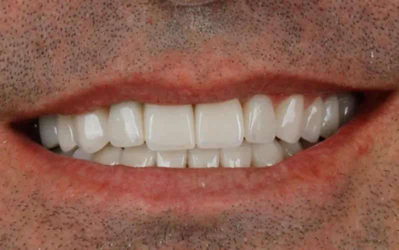 Depois — Lentes de contato de porcelana