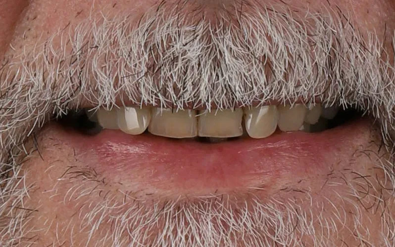 Antes — Implantes com coroas de porcelana