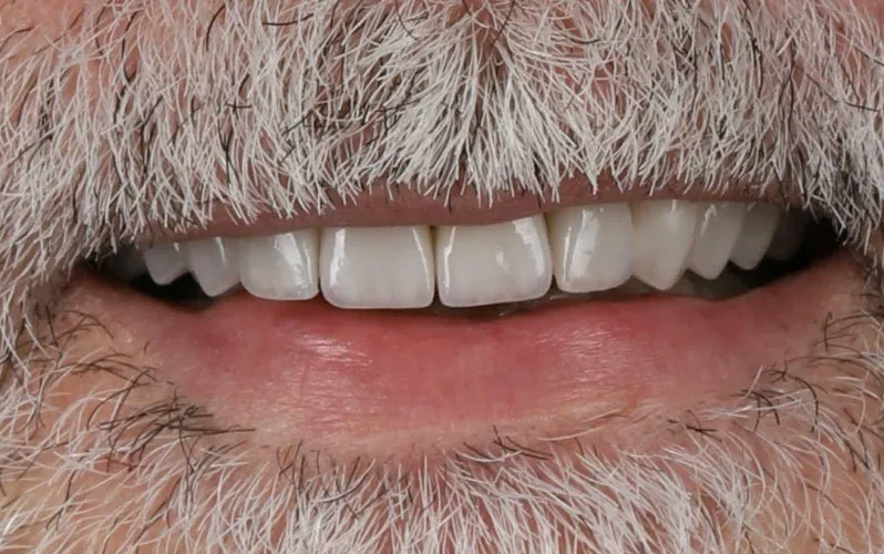 Depois — Implantes com coroas de porcelana
