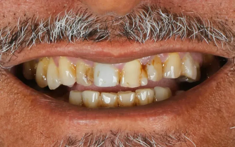 Antes — Clareamento + lentes de contato