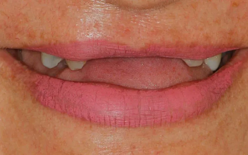 Antes — Coroas de porcelana sobre implantes