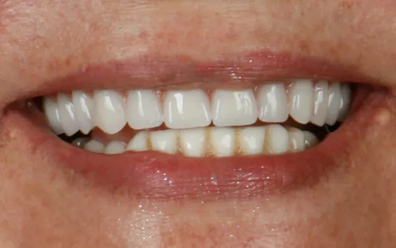 Depois — Coroas de porcelana sobre implantes