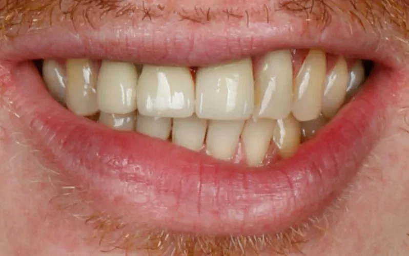 Antes — Protocolo Branemark sobre implantes
