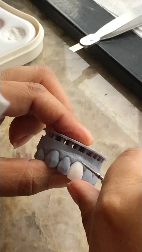 Laminados cerâmicos sendo esculpidos à mão no laboratório